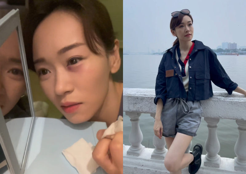 'I wouldn't be able to see now if it was any higher': Shirley Yeung sustains eye injury on set