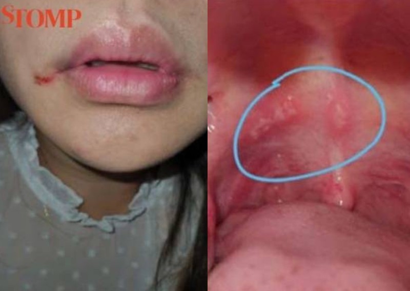 Woman scarred, in pain after 'most traumatic' dental treatment at Sengkang clinic