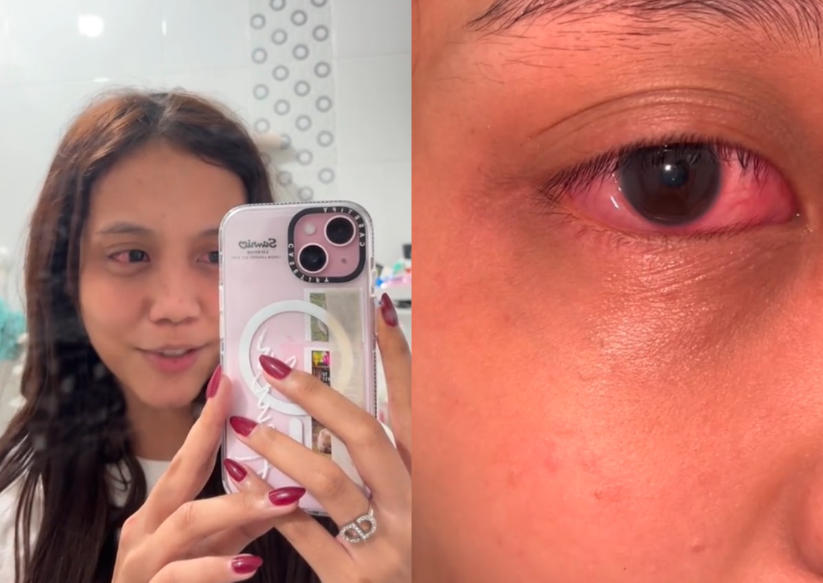 'Thankful I'm not blind': Woman gets eye infection allegedly after using contact lenses from TikTok Shop